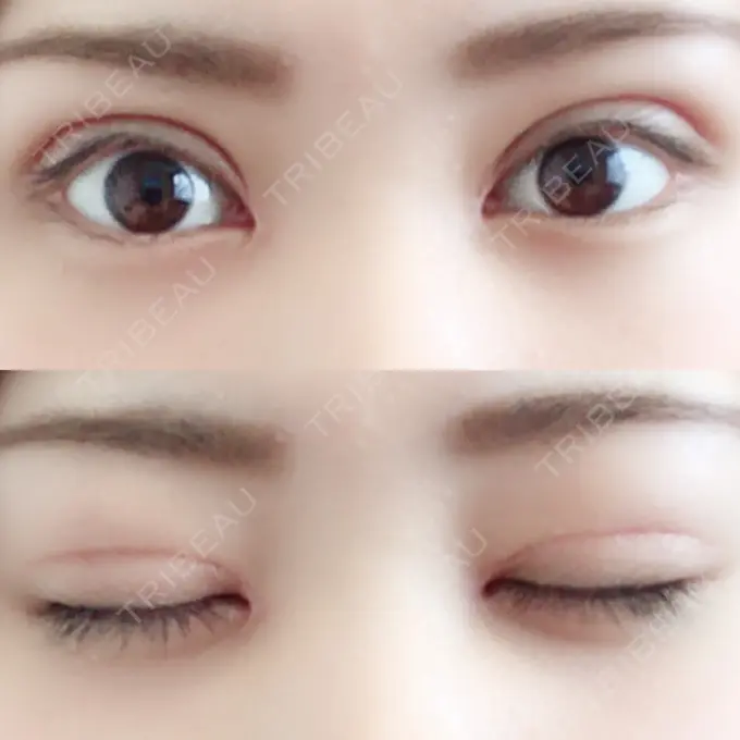 二重切開 / 目頭切開 城本クリニック 豊橋院 DAY 31 メイン用