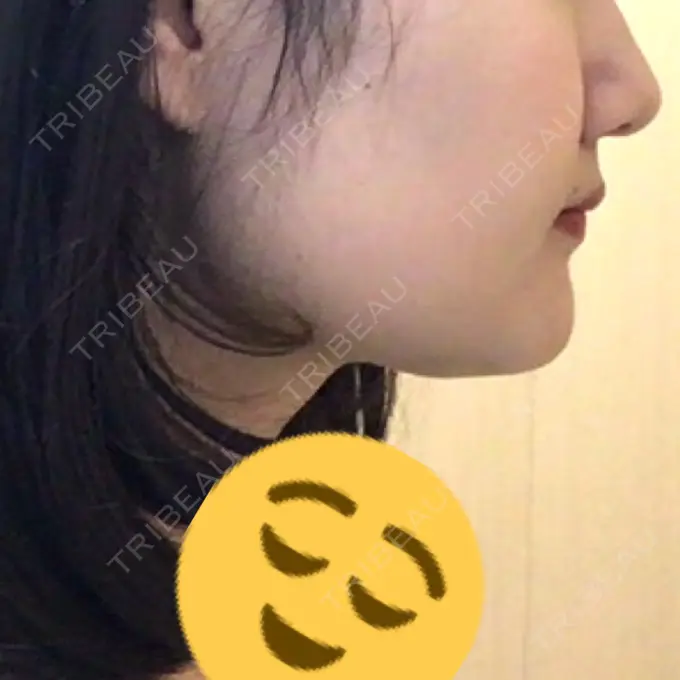 脂肪吸引（顔） アサミ美容外科 渋谷院 DAY 41 メイン用