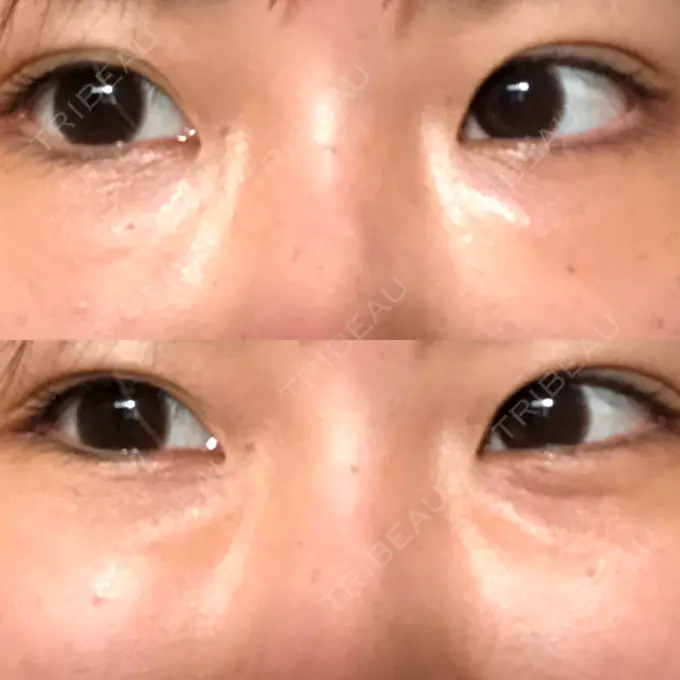 クマ治療 韓国ST美容整形外科 DAY 14 メイン用