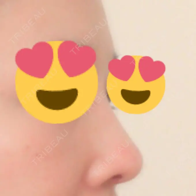 隆鼻術 / 鼻尖形成（切開） / 鼻中隔延長（切開） / 骨切幅寄せ / ワシ鼻修正・ハンプ切除 / ヒアルロン酸溶解 ミナ美容外科 DAY 85 メイン用