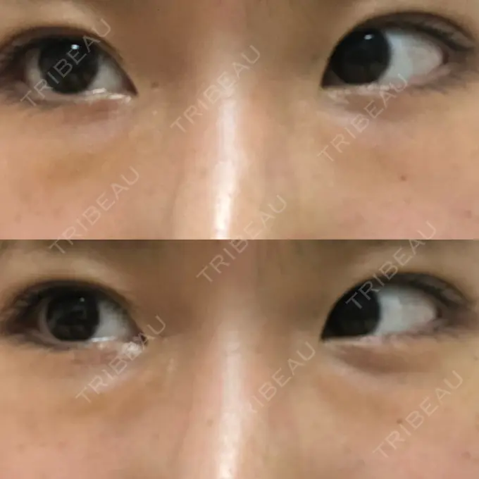 クマ治療 韓国ST美容整形外科 DAY 16 メイン用