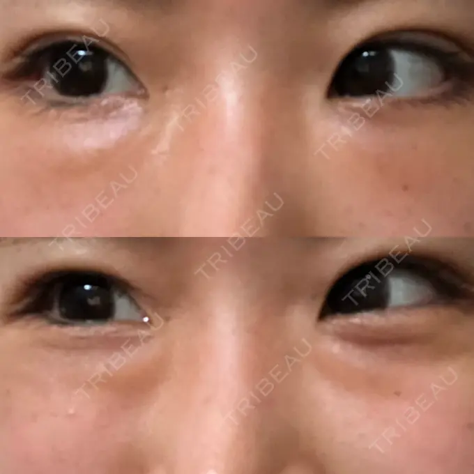 クマ治療 韓国ST美容整形外科 DAY 17 メイン用