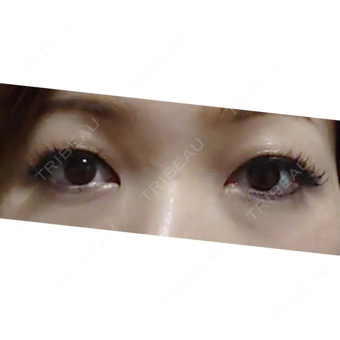 下まぶたたるみ取り 広島プルミエクリニック DAY 84 メイン用