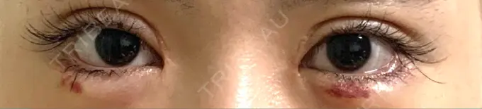 ヒアルロン酸注入（涙袋） リエンジャン整形外科 江南店 DAY 6 メイン用