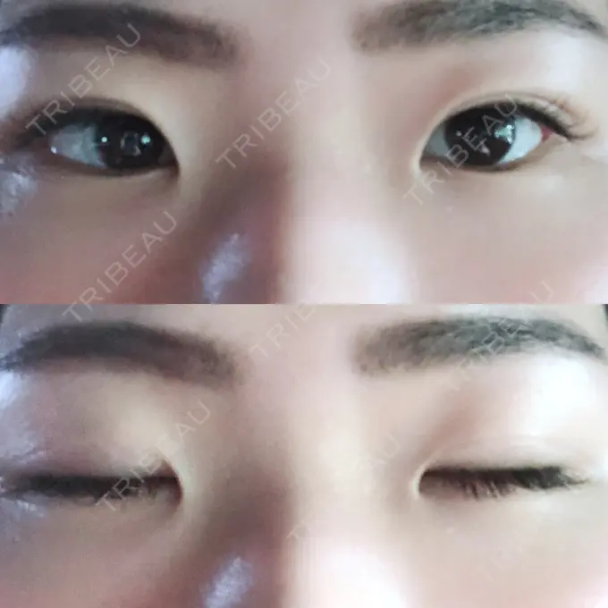 二重埋没 / 上まぶたの脂肪取り 東京ヒルズクリニック 岡崎院 AFTER メイン用