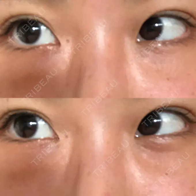 クマ治療 韓国ST美容整形外科 DAY 20 メイン用