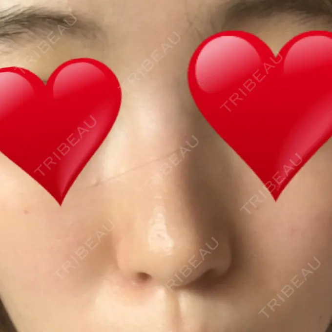 小鼻縮小（切開） プラストクリニック DAY 37 メイン用