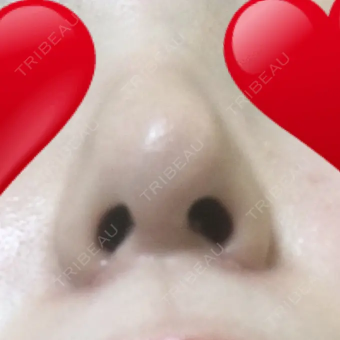 小鼻縮小（切開） プラストクリニック DAY 37 メイン用