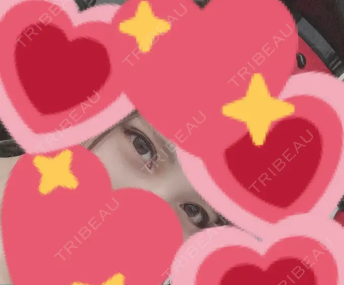 目尻切開 / 自然癒着法 FROM B整形外科 (旧バウム整形外科) AFTER メイン用