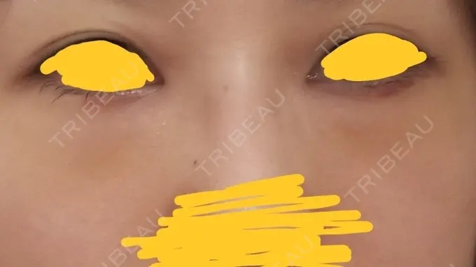 クマ治療 韓国ST美容整形外科 DAY 12 メイン用