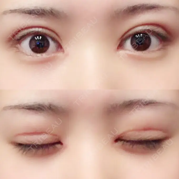 二重切開 / 目頭切開 城本クリニック 豊橋院 DAY 39 メイン用