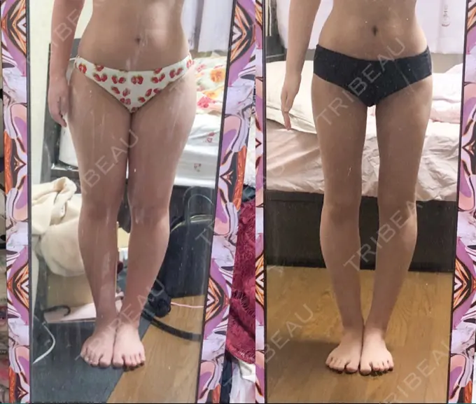 脂肪吸引（脚） / 脂肪吸引（お尻） / ボトックス（ふくらはぎ） ラインカルチャークリニック AFTER メイン用