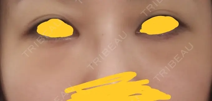 クマ治療 韓国ST美容整形外科 DAY 13 メイン用