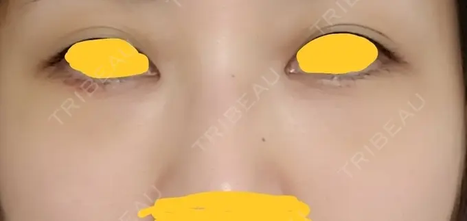 クマ治療 韓国ST美容整形外科 DAY 13 メイン用