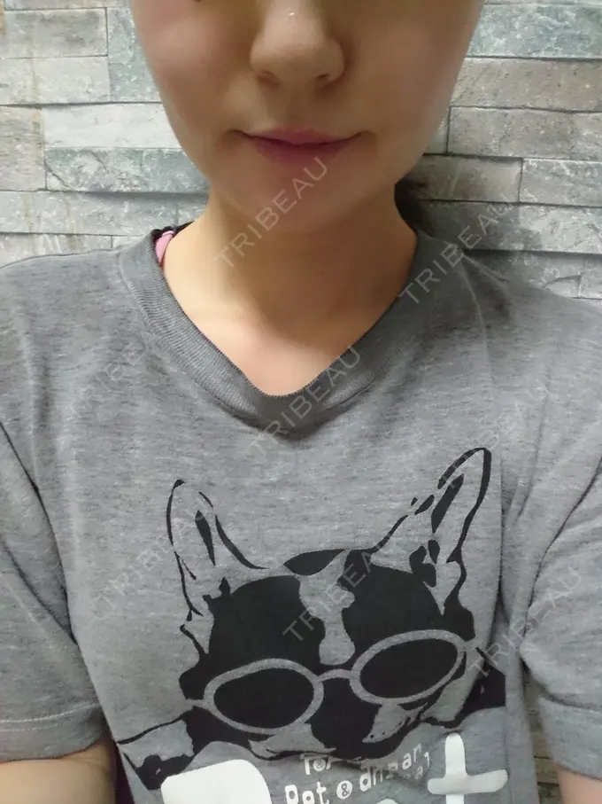 脂肪溶解注射（顔） ヴェリテクリニック 銀座院 AFTER メイン用