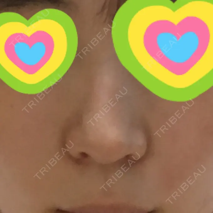 小鼻縮小（切開） プラストクリニック DAY 38 メイン用