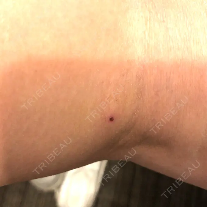 ボトックス（ふくらはぎ） REYOUNGクリニック DAY 3 メイン用