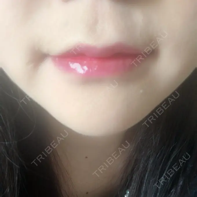 口唇縮小術 品川美容外科池袋院 AFTER メイン用