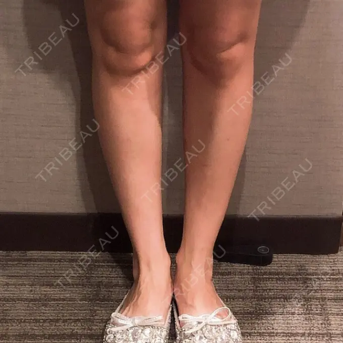 ボトックス（ふくらはぎ） REYOUNGクリニック DAY 4 メイン用