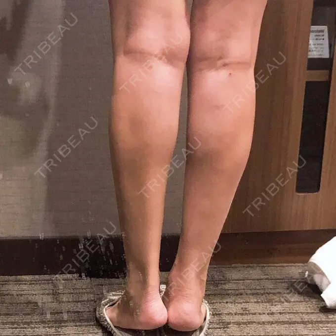 ボトックス（ふくらはぎ） REYOUNGクリニック DAY 4 メイン用