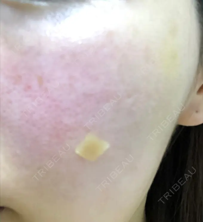 再生医療 プムクリニック新論峴店 DAY 0 メイン用