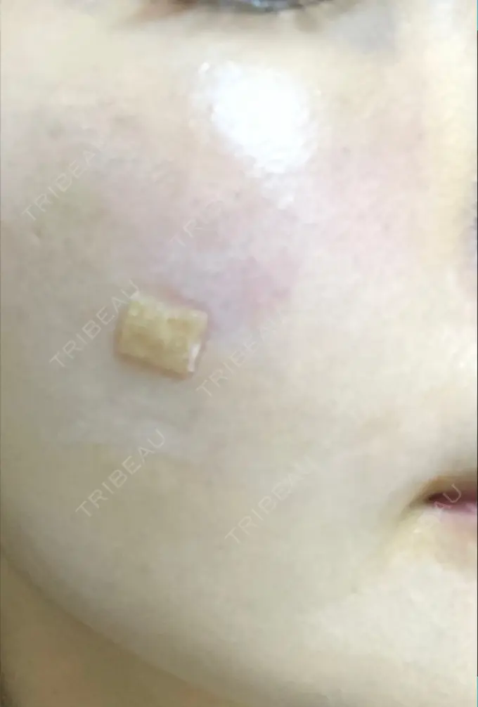 再生医療 プムクリニック新論峴店 DAY 1 メイン用