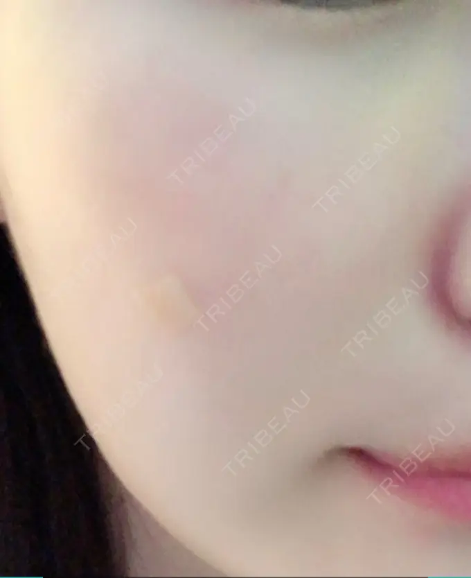 再生医療 プムクリニック新論峴店 DAY 3 メイン用