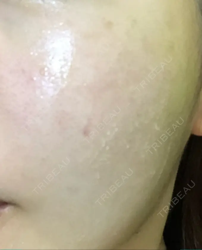 再生医療 プムクリニック新論峴店 DAY 3 メイン用