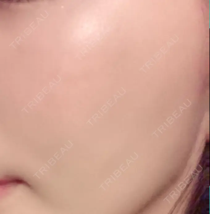 再生医療 プムクリニック新論峴店 AFTER メイン用