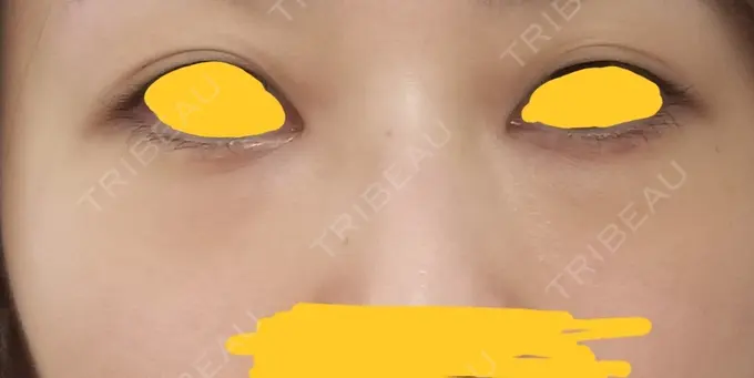 クマ治療 韓国ST美容整形外科 DAY 18 メイン用