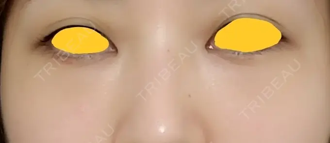 クマ治療 韓国ST美容整形外科 DAY 18 メイン用