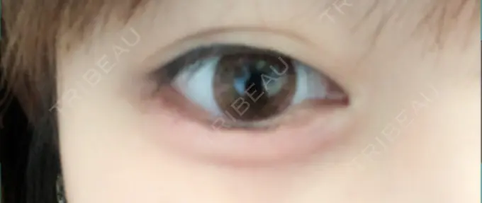 ヒアルロン酸注入（涙袋） 池田クリニック 大阪院 DAY 0 メイン用