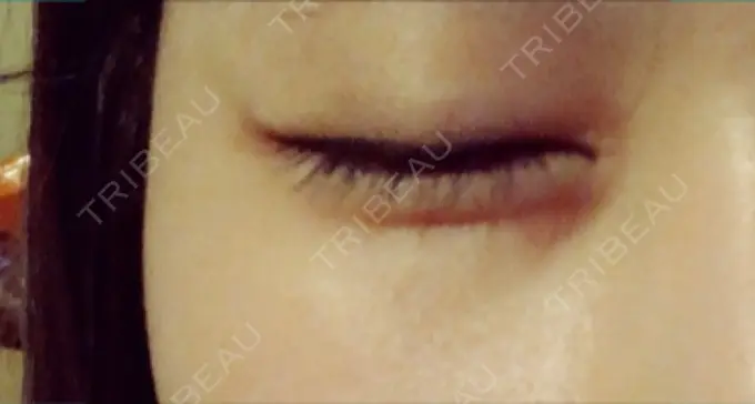 ヒアルロン酸注入（涙袋） 池田クリニック 大阪院 DAY 3 メイン用