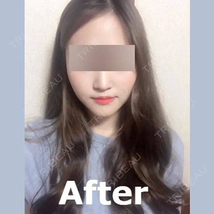 脂肪溶解注射（顔） id美容クリニック 銀座院 AFTER メイン用