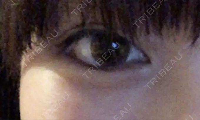 ヒアルロン酸注入（涙袋） 池田クリニック 大阪院 DAY 4 メイン用