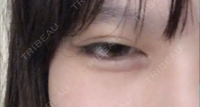 ヒアルロン酸注入（涙袋） 池田クリニック 大阪院 DAY 5 メイン用