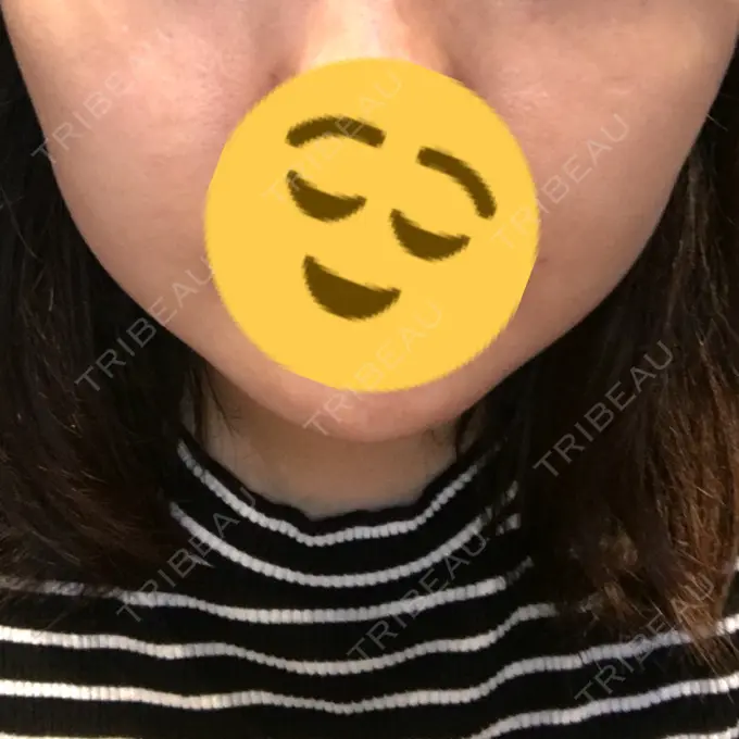 脂肪吸引（顔） アサミ美容外科 渋谷院 DAY 53 メイン用