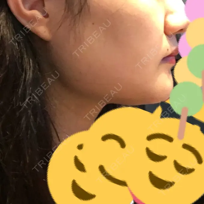 脂肪吸引（顔） アサミ美容外科 渋谷院 DAY 53 メイン用