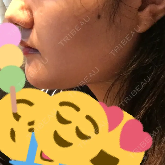 脂肪吸引（顔） アサミ美容外科 渋谷院 DAY 53 メイン用