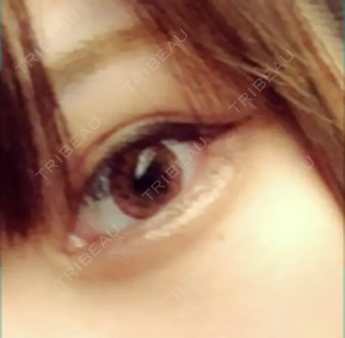 ヒアルロン酸注入（涙袋） 池田クリニック 大阪院 DAY 6 メイン用