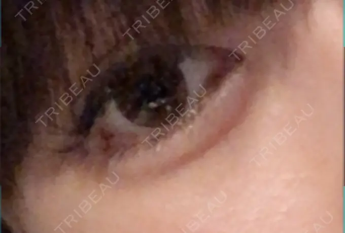 ヒアルロン酸注入（涙袋） 池田クリニック 大阪院 AFTER メイン用