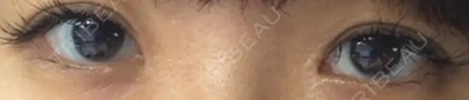 目頭切開 水の森美容クリニック 名古屋院 AFTER メイン用