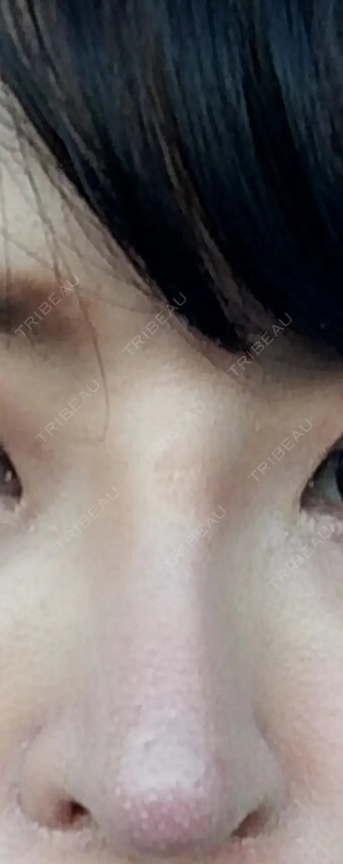 隆鼻術 / 鼻尖形成（切開） / 軟骨移植 ヤスミクリニック DAY 14 メイン用