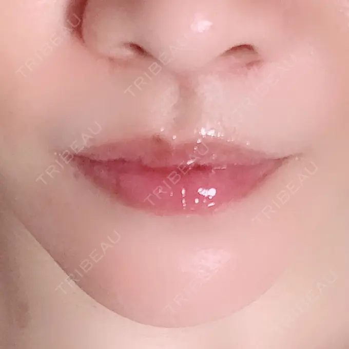 人中短縮 ドクターゴールドマンクリニック 大阪院 DAY 120 メイン用