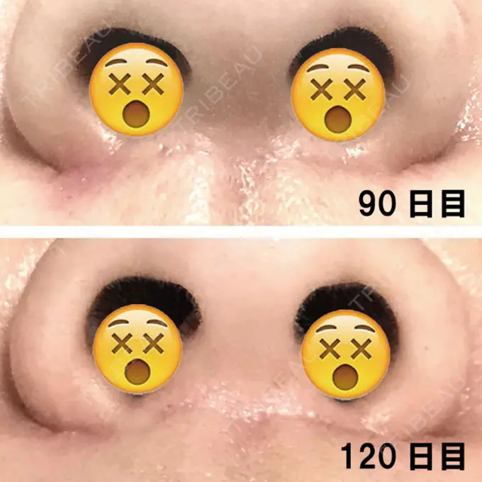 人中短縮 ドクターゴールドマンクリニック 大阪院 DAY 120 メイン用