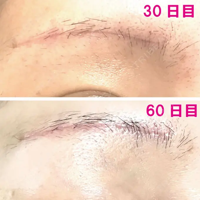 眉下切開 エイペックス美容外科 DAY 60 メイン用