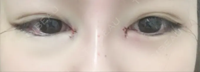 目頭切開 / 目尻切開 / ヒアルロン酸注入（鼻） 麹町皮ふ科・形成外科クリニック DAY 0 メイン用