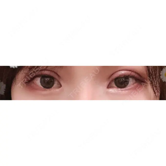 二重切開 / 目頭切開 / 上まぶたの脂肪取り / 蒙古ひだ形成 FROM B整形外科 (旧バウム整形外科) DAY 25 メイン用