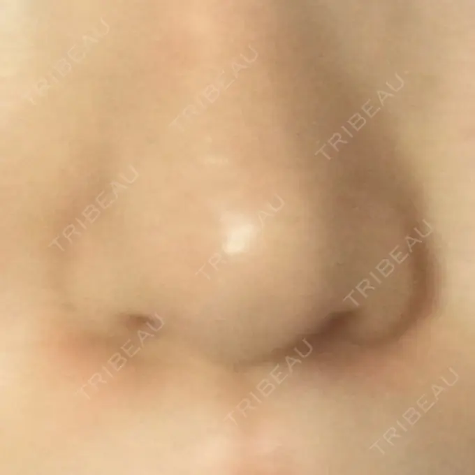小鼻縮小（切開） プラストクリニック DAY 47 メイン用