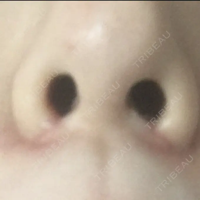 小鼻縮小（切開） プラストクリニック DAY 47 メイン用